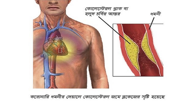 করোনারি হৃদরোগের কারণ